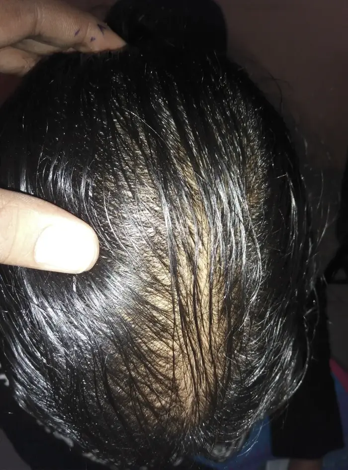 Female Pattern Baldness case 1 after treatment